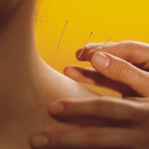 Dry Needling