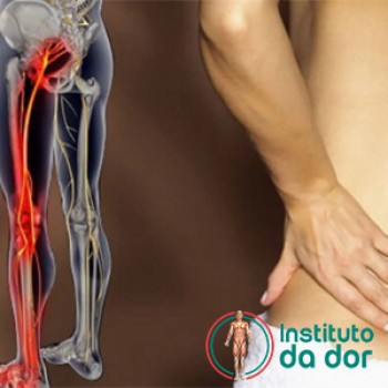 Tratamento para síndrome do piriforme em Torres Tibagy - Guarulhos