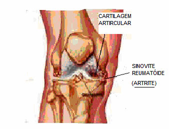 Artrite