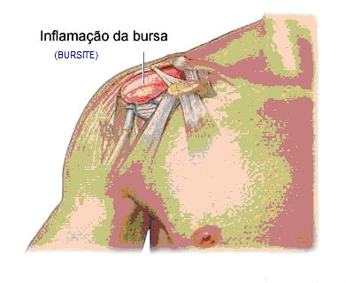 Capsulite articular