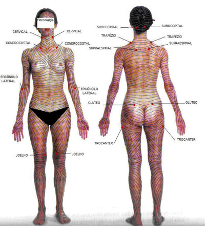 Fibromialgia